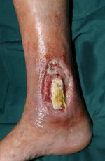 Chronisch infizierte Wunde am Fuß